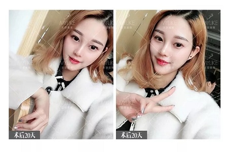 顏值：鼻子的改變能讓一個女孩變化有多大？