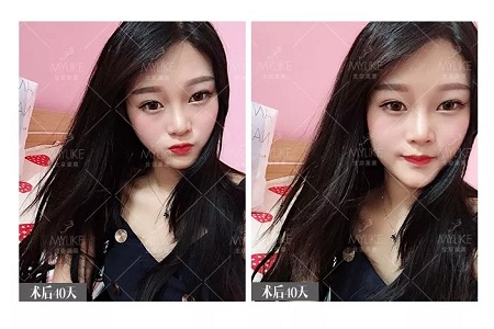 顏值：鼻子的改變能讓一個女孩變化有多大？