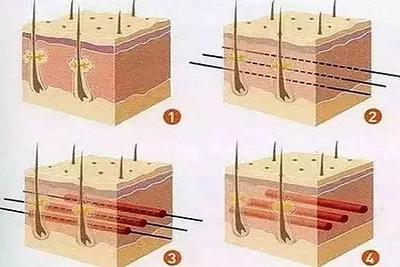 問診室：做*雕，到底要多少根線才好？