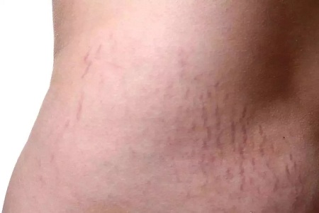 為什么瘦人也會(huì)有“肥胖紋”？