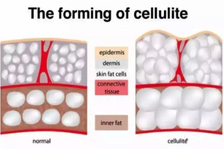 為什么瘦人也會(huì)有“肥胖紋”？