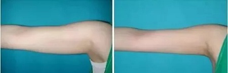 聽說很多不敢露胳膊的女生，胳膊上都有這個bug