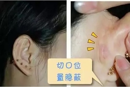 什么，隆鼻方式竟然有這么多種？