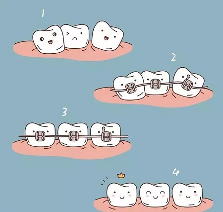 做牙齒矯正 ，真的要趁早！