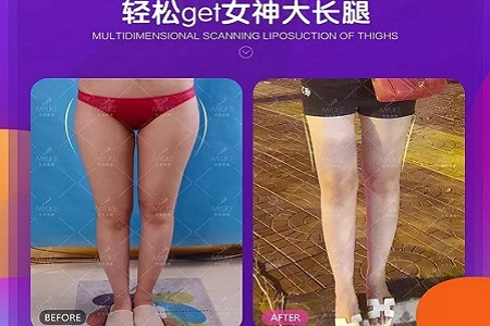 醫(yī)美白皮書：吸脂等于減肥嗎？