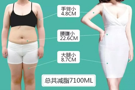 問診室：<a href='/xzjf/' target='_blank'><u>吸脂減肥</u></a>的四種誤區(qū)