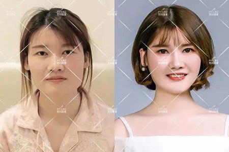 你討厭的脂肪，用在臉上就是寶貝！