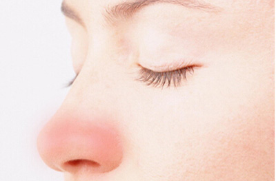 酒糟鼻怎么治療？