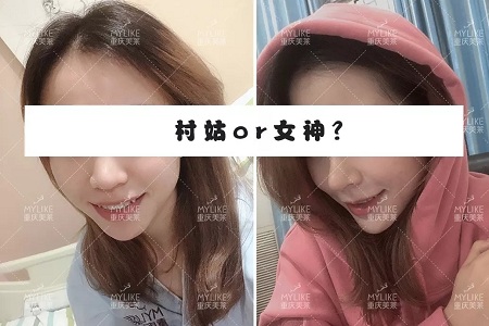 糾結！鼻頭太圓想塑形是用肋軟骨還是耳軟骨好？