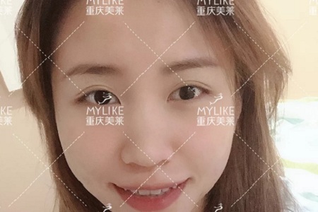 糾結！鼻頭太圓想塑形是用肋軟骨還是耳軟骨好？