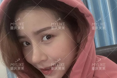 糾結！鼻頭太圓想塑形是用肋軟骨還是耳軟骨好？