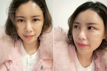 讓明星“一夜回春”的自體脂肪到底適不適合你？