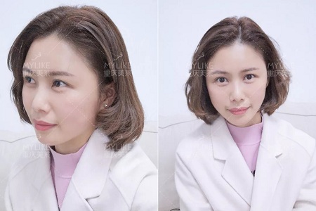 讓明星“一夜回春”的自體脂肪到底適不適合你？