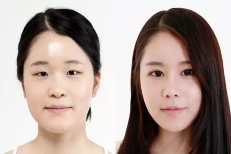 雙眼皮+開眼角為什么是較佳拍檔，一分鐘帶你看懂！