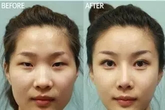 雙眼皮+開眼角為什么是較佳拍檔，一分鐘帶你看懂！