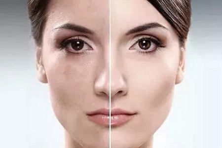 祛了那么多年的斑，你的斑去掉了嗎？