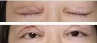 市面上五花八門的雙眼皮項目，如何有效找到你的菜？