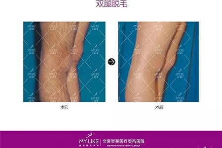 新品：黑科技脫毛金標(biāo)準(zhǔn)了解一下？