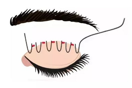 問診室：做雙眼皮前，這些問題你需要提前了解！