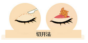 雙眼皮我想做埋線，為什么醫(yī)師建議我做全切雙眼皮