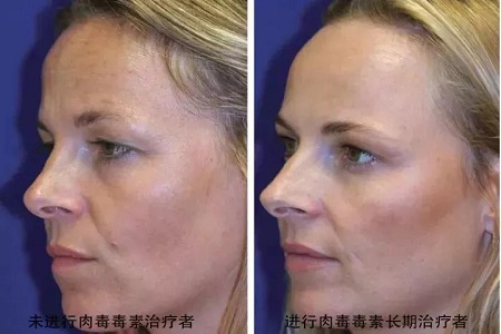 你無(wú)法用玻尿酸除掉所有皺紋！