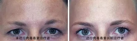 你無(wú)法用玻尿酸除掉所有皺紋！