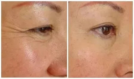 你無(wú)法用玻尿酸除掉所有皺紋！