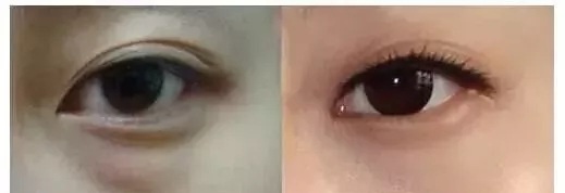 每到放假，做這個項目的人就會增多！--眼袋