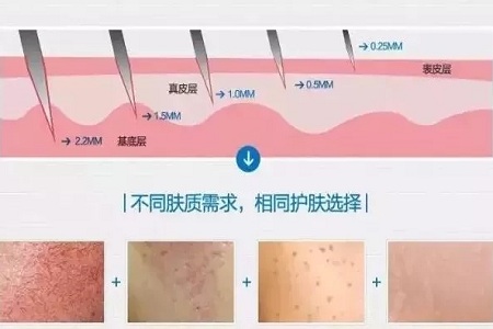 解密抗衰秘籍——中胚層療法