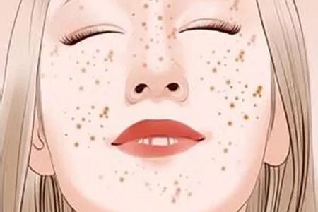 問診室：祛斑不難，找對病因才是重點，祛斑較全面科普看過來