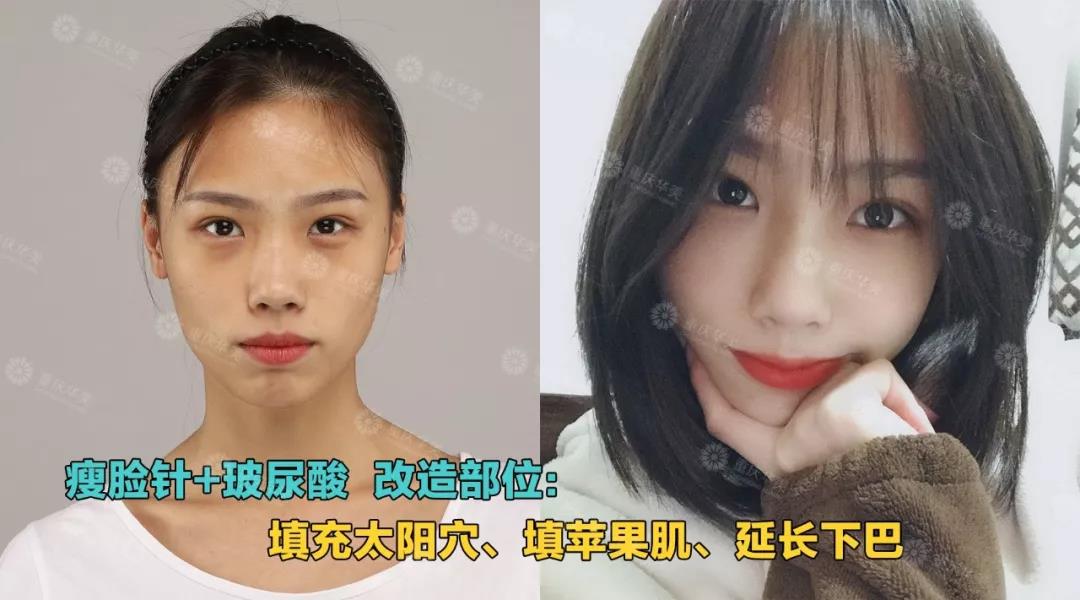 玻尿酸+瘦臉這樣打，方臉、大餅臉都能變小V臉！