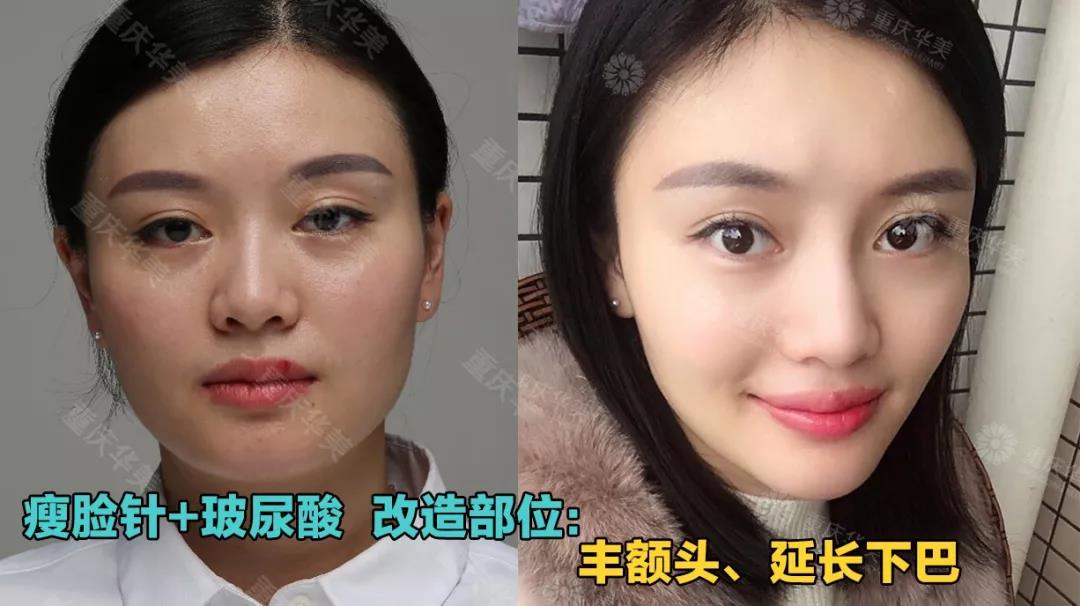 玻尿酸+瘦臉這樣打，方臉、大餅臉都能變小V臉！