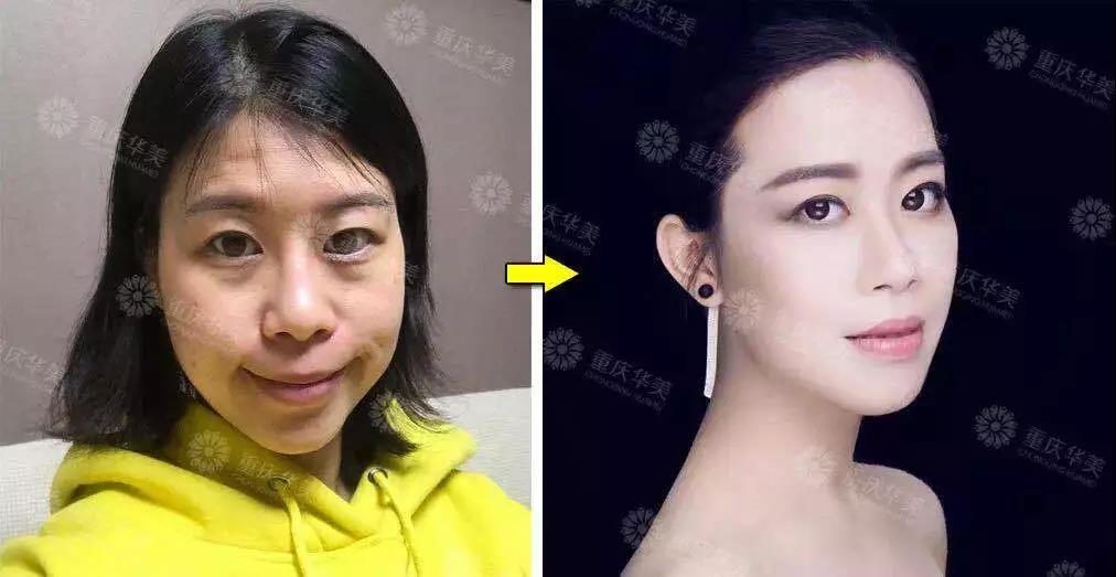 玻尿酸+瘦臉這樣打，方臉、大餅臉都能變小V臉！