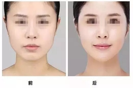 美萊實驗室：瘦臉、ReFa都解決不了你的臉大問題交給我就對了