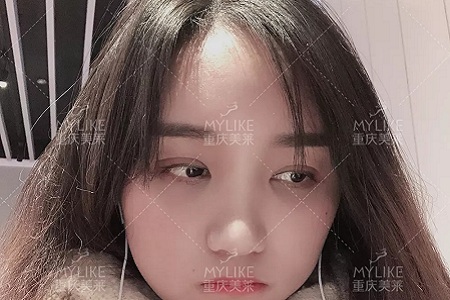 自體脂肪+雙眼皮，這對(duì)cp你不pick一下嗎？