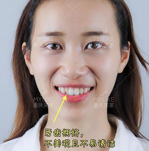 這種牙齒矯正方式，96%的人都會選擇！