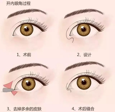 美萊實(shí)驗(yàn)室：開眼角就是醫(yī)師想多收錢？