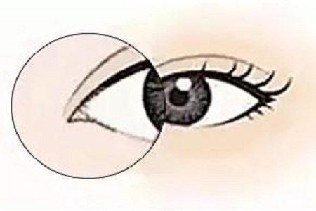 美萊實(shí)驗(yàn)室：開眼角就是醫(yī)師想多收錢？