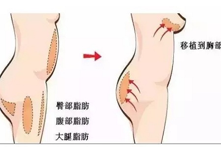 問診室：你說脂肪壓得你好累，殊不知它也可以是寶貝