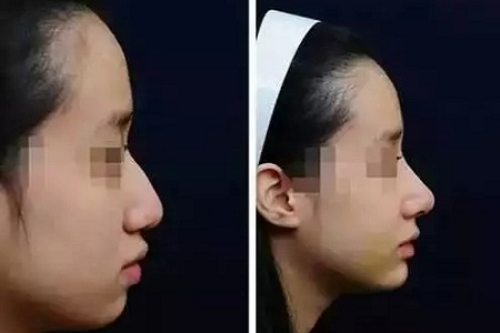 噓！你想不想隨心所欲的美？選擇玻尿酸吧！