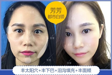 噓！你想不想隨心所欲的美？選擇玻尿酸吧！