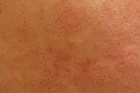 粗糙、毛孔粗大、起皮......換季肌膚問題如何解決？