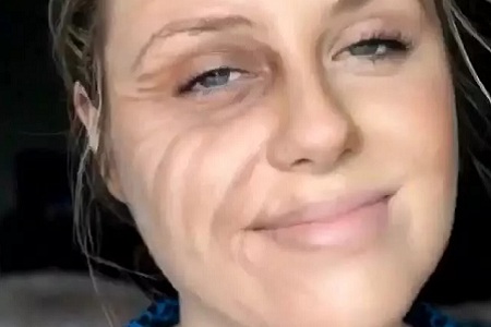 用玻尿酸治療鼻唇溝，一定要注意這種情況！