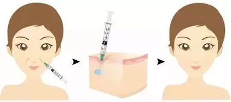 用玻尿酸治療鼻唇溝，一定要注意這種情況！