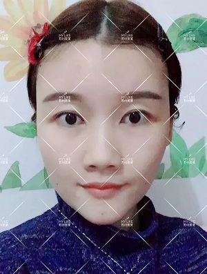 面部填充會(huì)不會(huì)把臉填大？