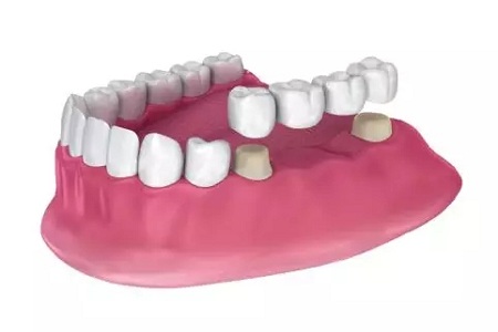 牙齒缺失時，選烤瓷牙還是那種？