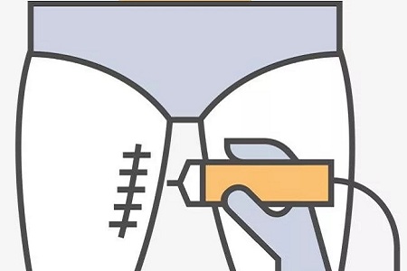 吸脂=減肥？這些常見的吸脂誤區(qū)你經(jīng)歷過嗎？