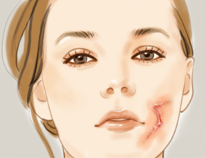 激光祛疤手術(shù)多少錢(qián)