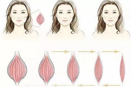不敢瘦臉？擔(dān)心打完臉頰凹？
