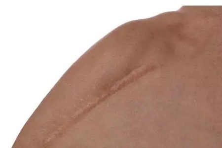 疤痕體質(zhì)不能做整形項(xiàng)目了嗎？